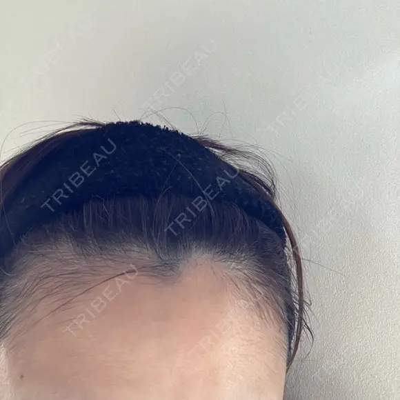 ピーリング（ニキビ・毛穴） 成城スカイファミリークリニック DAY 3 メイン用