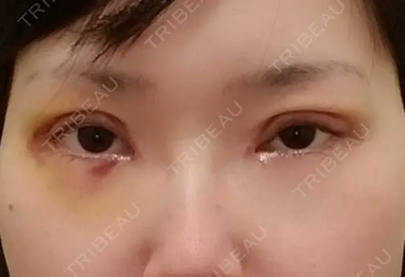 二重切開 / 目頭切開 / 眼瞼下垂（切開） / 目元修正 聖心美容クリニック 札幌院 DAY 5 メイン用