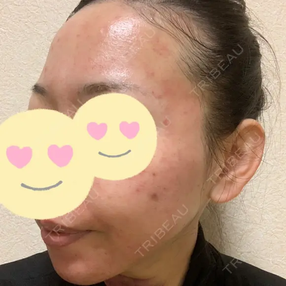 脂肪吸引（顔） / 脂肪注入（肌） / ヒアルロン酸注入（あご） / ボトックス（エラ・小顔） / ダーマペン Mods Clinic（モッズクリニック） 大阪院 DAY 1 メイン用