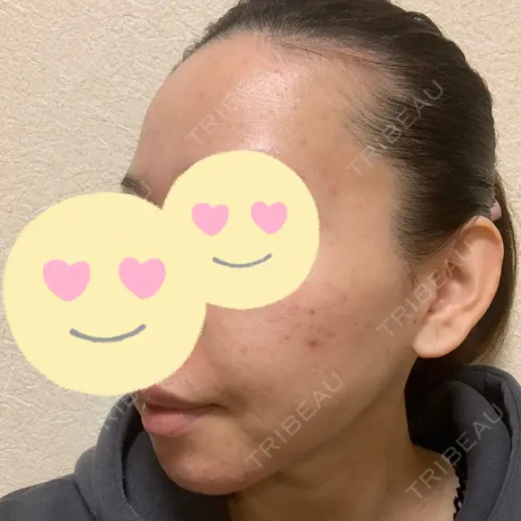 脂肪吸引（顔） / 脂肪注入（肌） / ヒアルロン酸注入（あご） / ボトックス（エラ・小顔） / ダーマペン Mods Clinic（モッズクリニック） 大阪院 DAY 7 メイン用