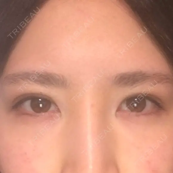 二重埋没 アリエル美容クリニック 郡山院 DAY 3 メイン用