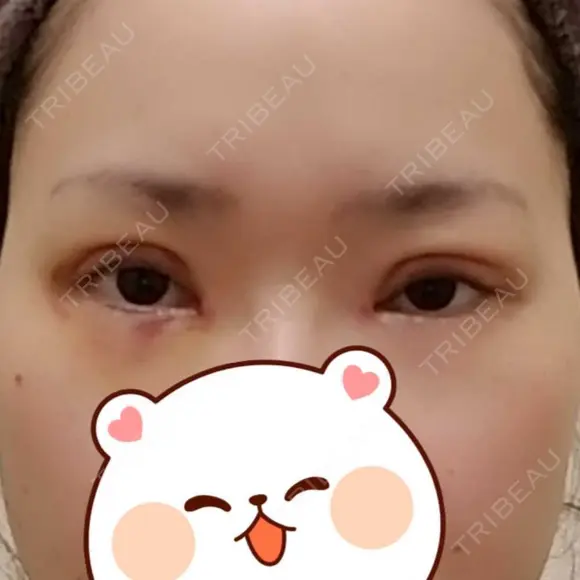 二重切開 / 目頭切開 / 眼瞼下垂（切開） / 目元修正 聖心美容クリニック 札幌院 DAY 7 メイン用