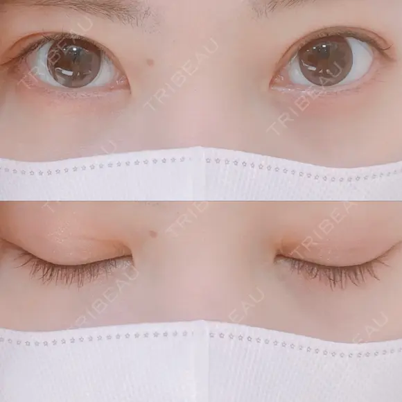 二重埋没 AILE Clinic DAY 60 メイン用