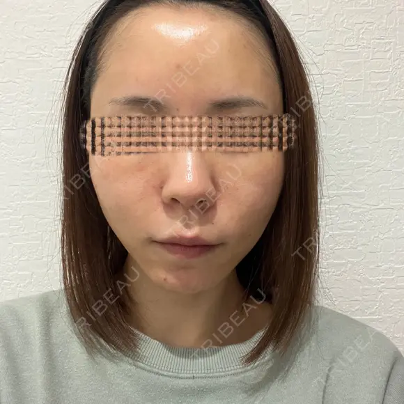 額を丸く / 脂肪注入（肌） / 脂肪注入（額） / 脂肪注入（輪郭） EMMA CLINIC（エマクリニック） DAY 14 メイン用