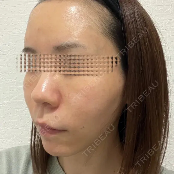 額を丸く / 脂肪注入（肌） / 脂肪注入（額） / 脂肪注入（輪郭） EMMA CLINIC（エマクリニック） DAY 14 メイン用