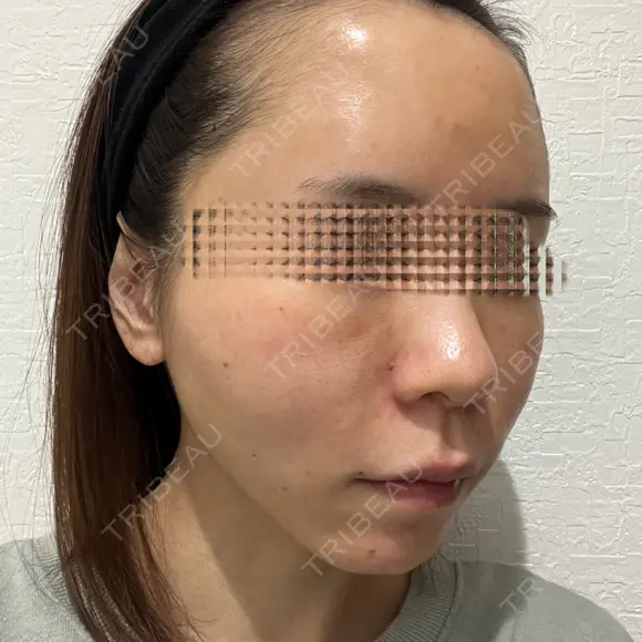 額を丸く / 脂肪注入（肌） / 脂肪注入（額） / 脂肪注入（輪郭） EMMA CLINIC（エマクリニック） DAY 14 メイン用