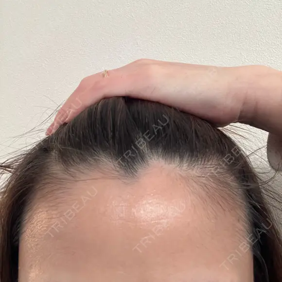 ピーリング（ニキビ・毛穴） 成城スカイファミリークリニック DAY 5 メイン用