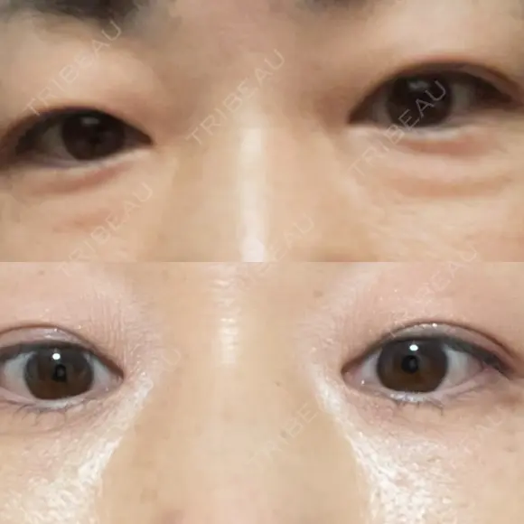 クマ治療 / 脂肪注入（肌） / ボトックス（あご） 銀座みゆき通り美容外科 大阪梅田院 AFTER メイン用