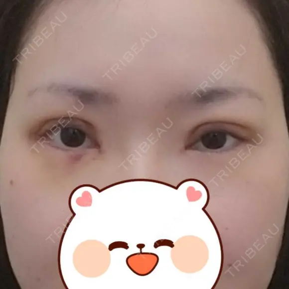 二重切開 / 目頭切開 / 眼瞼下垂（切開） / 目元修正 聖心美容クリニック 札幌院 DAY 9 メイン用