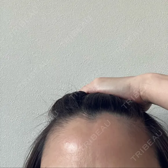 ピーリング（ニキビ・毛穴） 成城スカイファミリークリニック DAY 6 メイン用