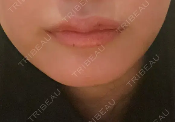 ヒアルロン酸注入（涙袋） / 肌ヒアルロン酸注入（たるみ・シワ改善） / ヒアルロン酸注入（唇） / ヒアルロン酸注入（額） / ヒアルロン酸注入（頬） LA CLEF CLINIC（ラクレクリニック） DAY 2 メイン用