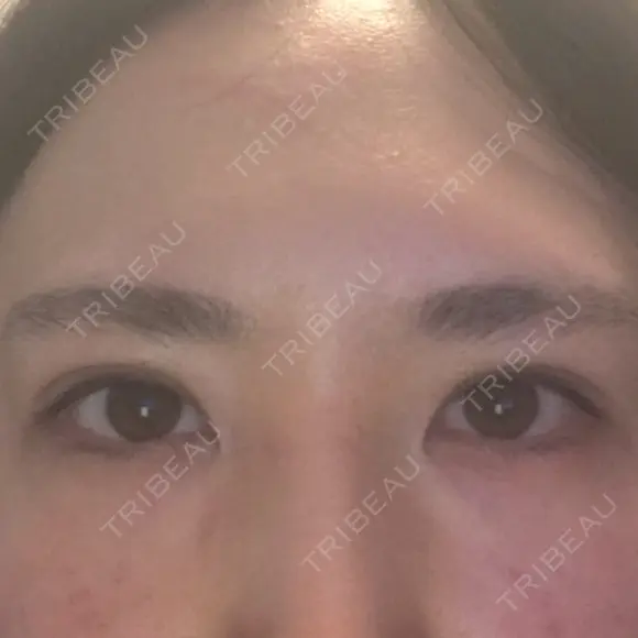 二重埋没 アリエル美容クリニック 郡山院 DAY 6 メイン用