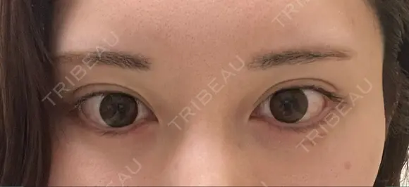 タレ目形成・グラマラスライン（切開） / タレ目形成・グラマラスライン（埋没） リッツ美容外科 東京院 AFTER メイン用