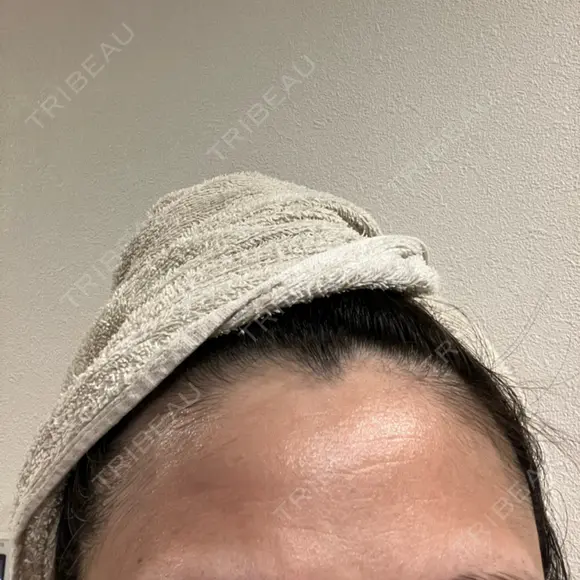 ピーリング（ニキビ・毛穴） 成城スカイファミリークリニック DAY 7 メイン用