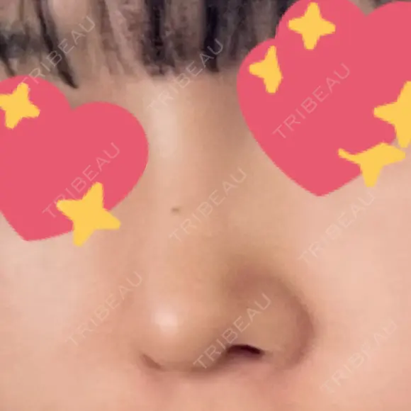 隆鼻術 / 鼻尖形成（切開） / 鼻中隔延長（切開） / 軟骨移植 R Beauty CLINIC 名古屋院 AFTER メイン用