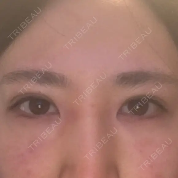 二重埋没 アリエル美容クリニック 郡山院 DAY 7 メイン用