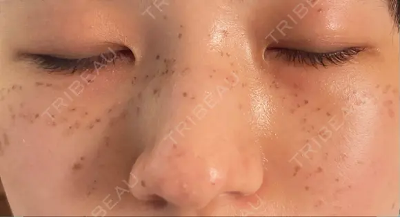 ピコスポット Olino美容外科・美容皮膚科 DAY 3 メイン用