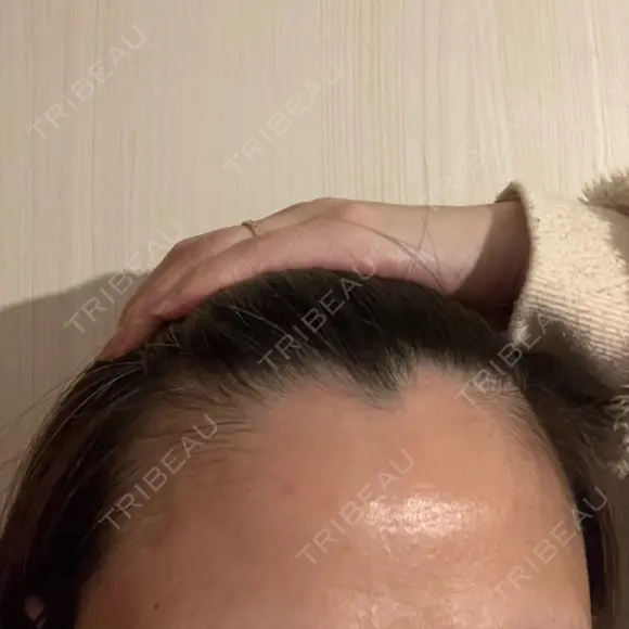 ピーリング（ニキビ・毛穴） 成城スカイファミリークリニック DAY 8 メイン用