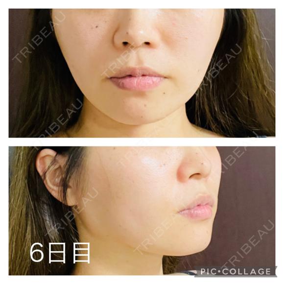 糸リフト アリエル美容クリニック 郡山院 DAY 6 メイン用