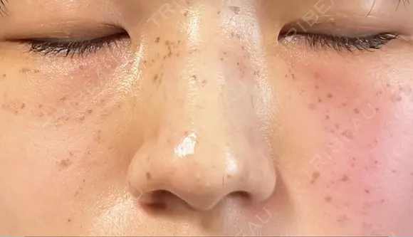 ピコスポット Olino美容外科・美容皮膚科 DAY 4 メイン用