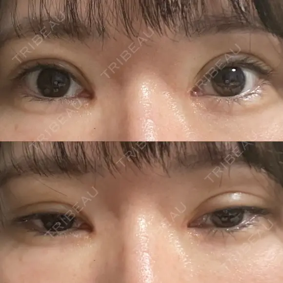 二重切開 / 目頭切開 聖心美容クリニック 札幌院 DAY 31 メイン用