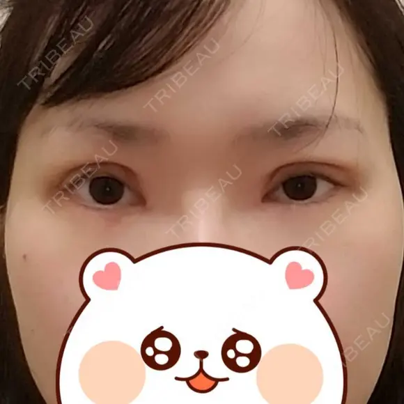 二重切開 / 目頭切開 / 眼瞼下垂（切開） / 目元修正 聖心美容クリニック 札幌院 DAY 12 メイン用