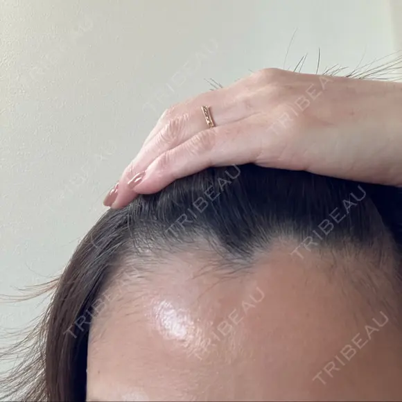 ピーリング（ニキビ・毛穴） 成城スカイファミリークリニック DAY 10 メイン用