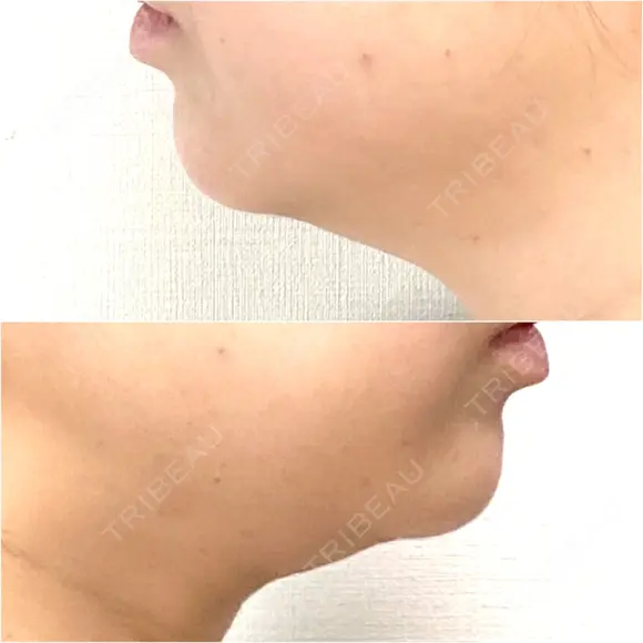 ボトックス（エラ・小顔） / 脂肪溶解注射（顔） / 脂肪溶解注射 渋谷美容外科クリニック 渋谷院 DAY 0 メイン用