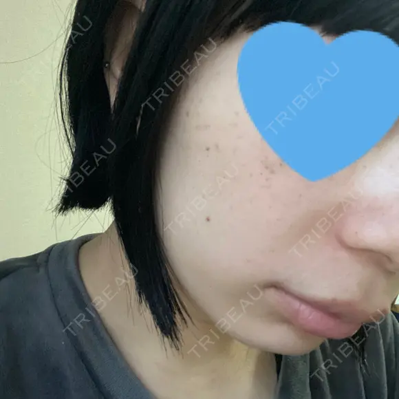 光治療（フォトフェイシャルなど） 椿クリニック 名古屋院 DAY 3 メイン用