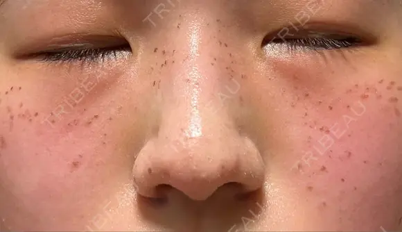 ピコスポット Olino美容外科・美容皮膚科 DAY 5 メイン用