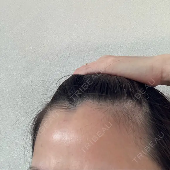 ピーリング（ニキビ・毛穴） 成城スカイファミリークリニック AFTER メイン用