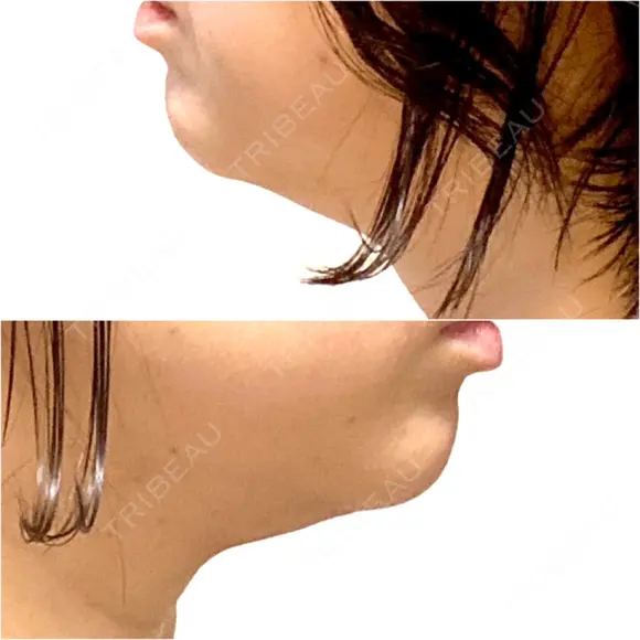 ボトックス（エラ・小顔） / 脂肪溶解注射（顔） / 脂肪溶解注射 渋谷美容外科クリニック 渋谷院 DAY 1 メイン用