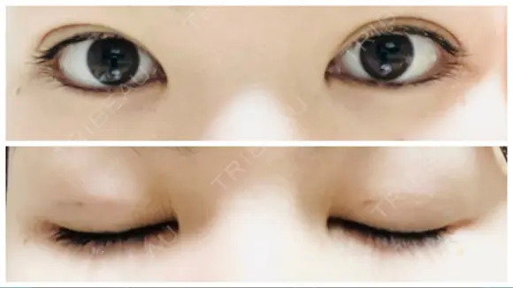 二重埋没 アリエル美容クリニック 郡山院 DAY 2 メイン用