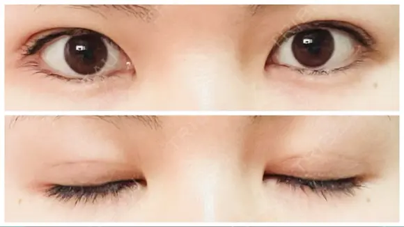 二重埋没 アリエル美容クリニック 郡山院 DAY 3 メイン用