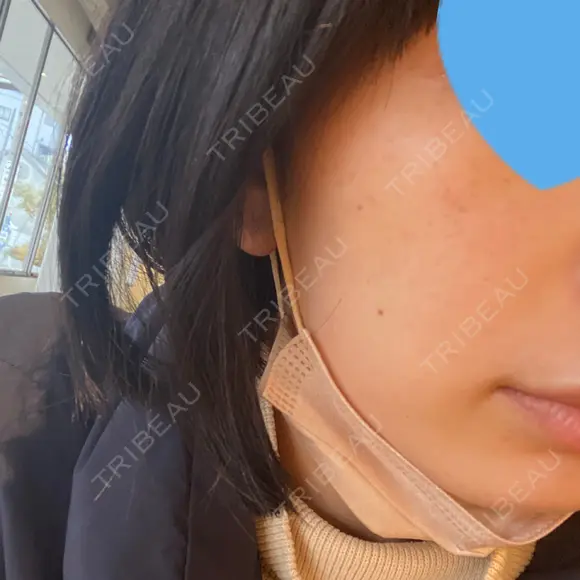 光治療（フォトフェイシャルなど） 椿クリニック 名古屋院 DAY 4 メイン用