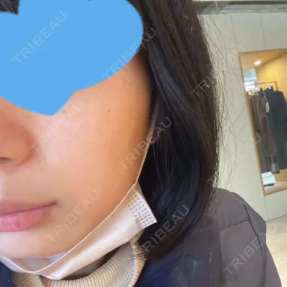 光治療（フォトフェイシャルなど） 椿クリニック 名古屋院 DAY 4 メイン用