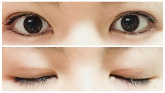 二重埋没 アリエル美容クリニック 郡山院 DAY 5 メイン用