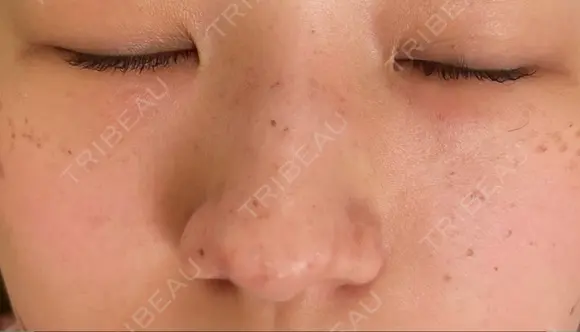 ピコスポット Olino美容外科・美容皮膚科 DAY 7 メイン用