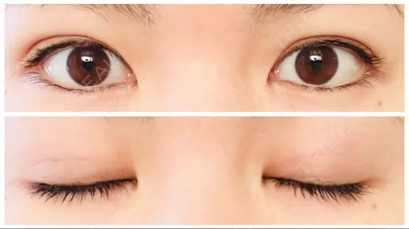 二重埋没 アリエル美容クリニック 郡山院 DAY 6 メイン用