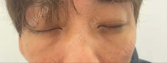 下まぶたの脂肪取り 東郷美容形成外科　福岡 AFTER メイン用