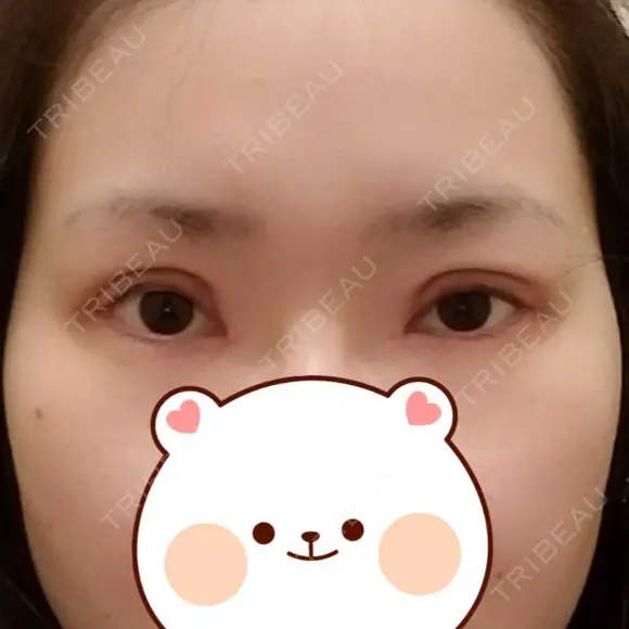 二重切開 / 目頭切開 / 眼瞼下垂（切開） / 目元修正 聖心美容クリニック 札幌院 DAY 16 メイン用