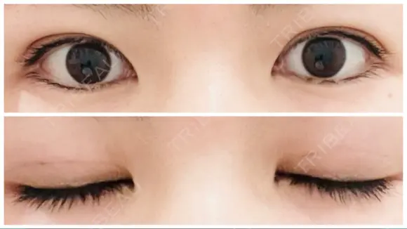 二重埋没 アリエル美容クリニック 郡山院 DAY 7 メイン用