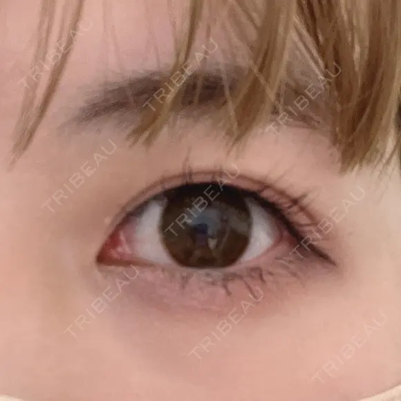 二重埋没 湘南美容クリニック 藤沢院 AFTER メイン用