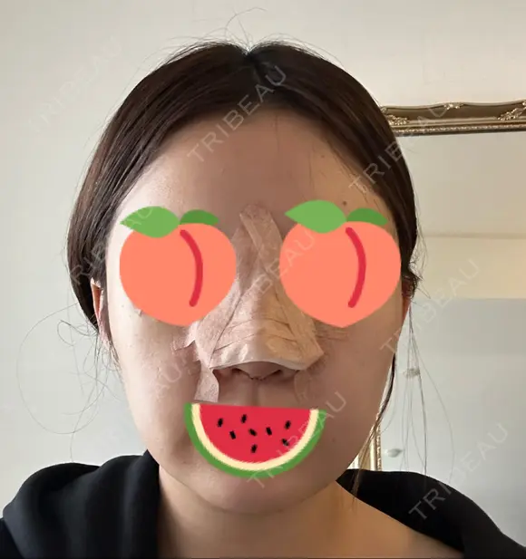 隆鼻術 / 鼻尖形成（切開） / 鼻中隔延長（切開） エースクリニック 名古屋院 AFTER メイン用