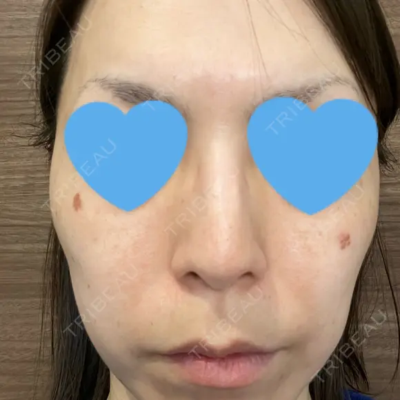 シミ取りレーザー / ピコレーザートーニング（美白・肝斑） フローラクリニック DAY 1 メイン用