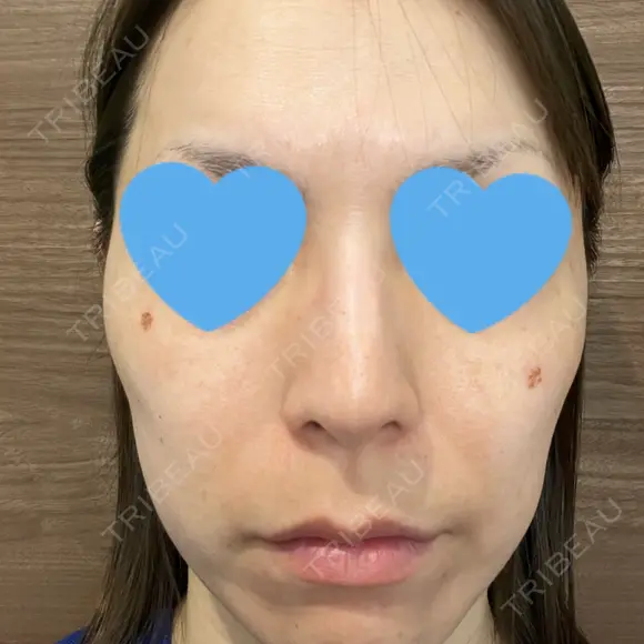 シミ取りレーザー / ピコレーザートーニング（美白・肝斑） フローラクリニック DAY 3 メイン用