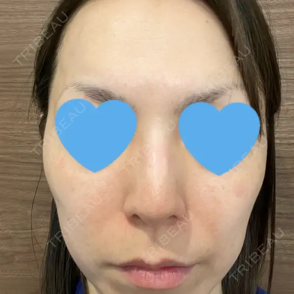 シミ取りレーザー / ピコレーザートーニング（美白・肝斑） フローラクリニック AFTER メイン用