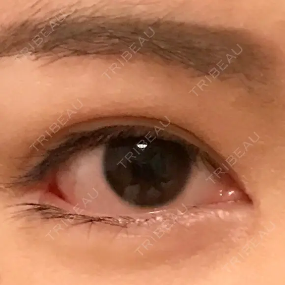 目頭切開 / 目尻切開 / 目尻靭帯移動 FROM B整形外科 (旧バウム整形外科) AFTER メイン用