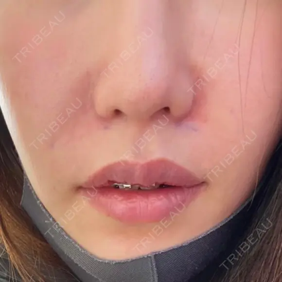 鼻翼基部形成（貴族手術） ジョウクリニック 大阪院 DAY 0 メイン用