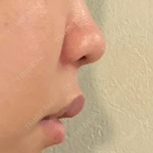 鼻翼基部形成（貴族手術） ジョウクリニック 大阪院 DAY 2 メイン用